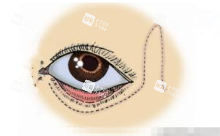 下眼瞼外翻動(dòng)畫(huà)展示圖.jpg