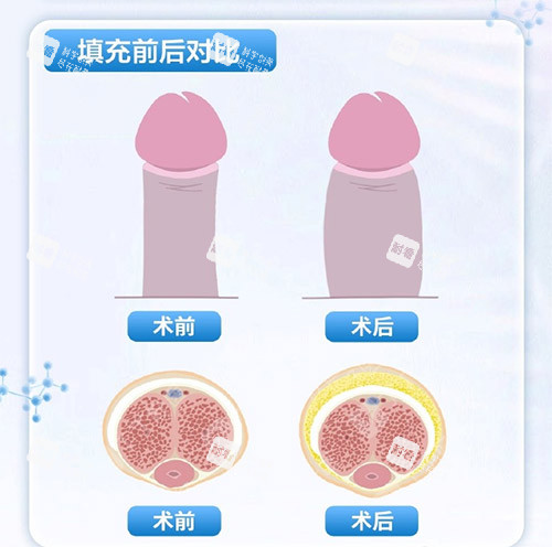 填充增大增粗示意圖