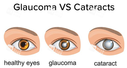 正常眼睛白內(nèi)障和青光眼