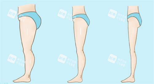 面部瘦臉選激光，腹部緊致選射頻？醫(yī)美醫(yī)師揭秘溶脂技術(shù)真相