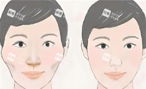 顴骨內(nèi)推會臉垮嗎？深度剖析手術(shù)原理與術(shù)后抗衰黃金法則