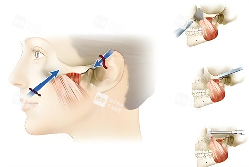 顴骨內(nèi)推手術(shù)原理動(dòng)畫圖