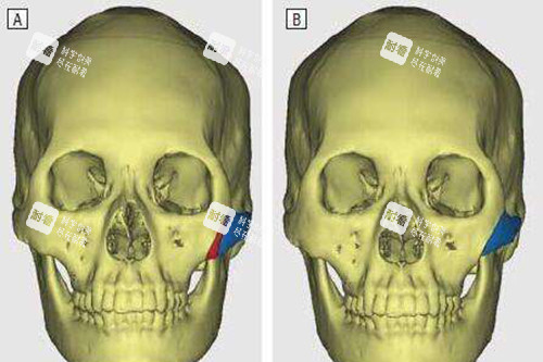 顴骨內(nèi)推示意圖