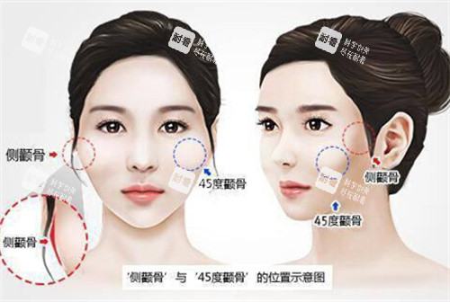 顴骨高突出演示動(dòng)畫圖