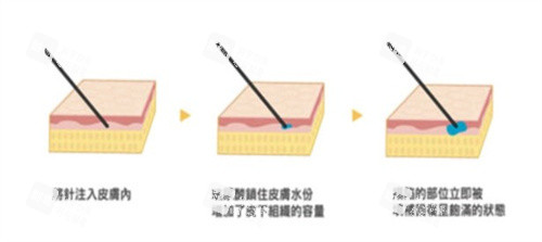 注射玻尿酸的原理