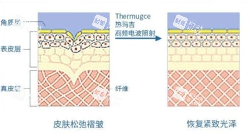 熱瑪吉作用在皮膚上皮下組織展示