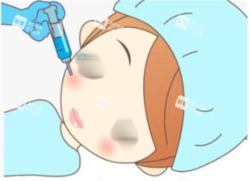 打完瘦臉凹陷多久能好？醫(yī)生揭秘：自然改善與醫(yī)學(xué)干預(yù)時(shí)間表