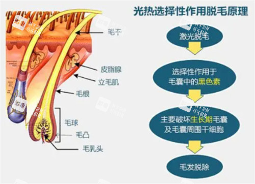 光子脫毛的原理