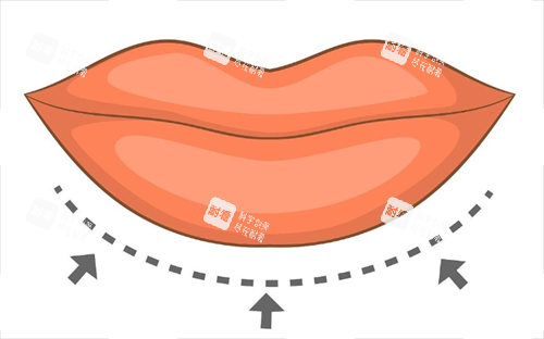 厚唇改薄畫線示意圖