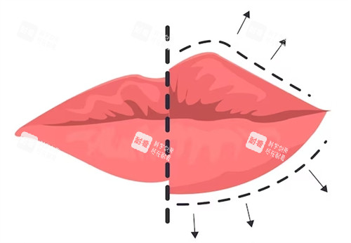 豐唇手術(shù)對比圖