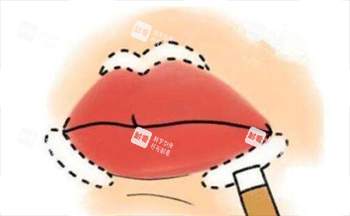 豐唇手術(shù)畫線示意圖