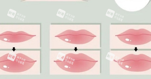 豐唇注射過程示意圖