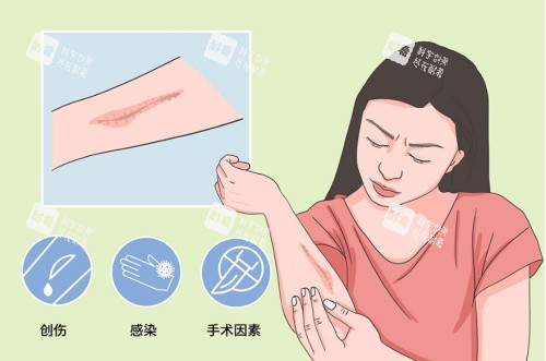 疤痕增生引起的因素示意圖