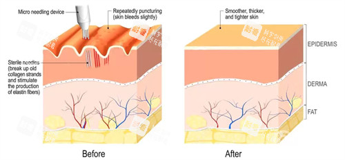 凹陷疤痕填充前后對比圖