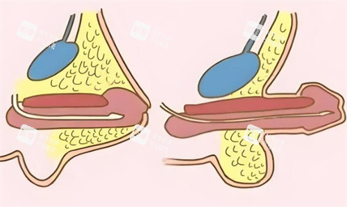 李世榮延長手術(shù)6.8萬起值不值？30年經(jīng)驗(yàn)，隱痕延長2-5cm不回縮