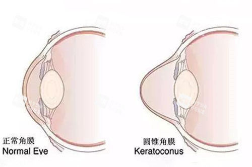 圓錐角膜與正常眼睛展示圖