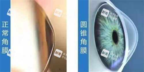 正常角膜與圓錐角膜圖片