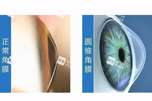圓錐角膜與正常角膜對比圖