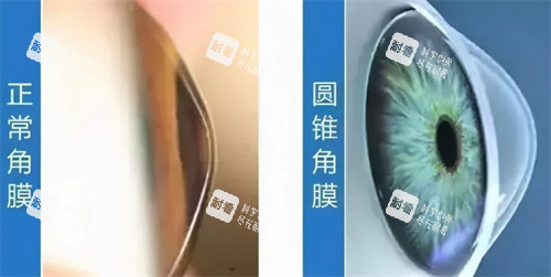 圓錐角膜和正常角膜的區(qū)別圖解