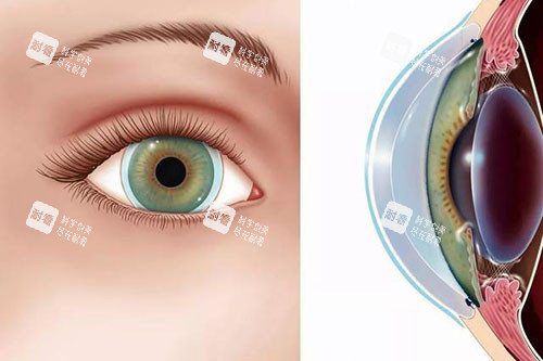 圓錐角膜卡通圖片