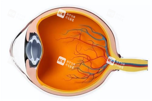 圓錐角膜的示意圖