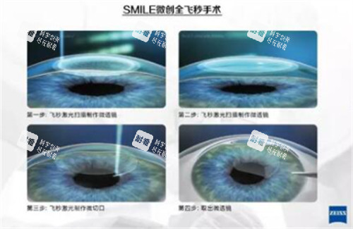 全飛秒手術(shù)過程圖解
