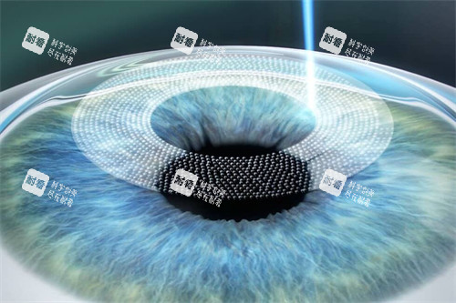 全飛秒手術(shù)動畫圖