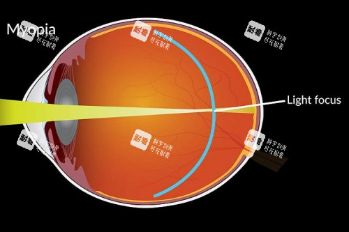 近視成像落在視網(wǎng)膜前