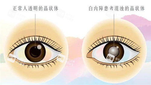 白內(nèi)障和正常眼球的對比圖 白內(nèi)障和正常眼球的對比圖