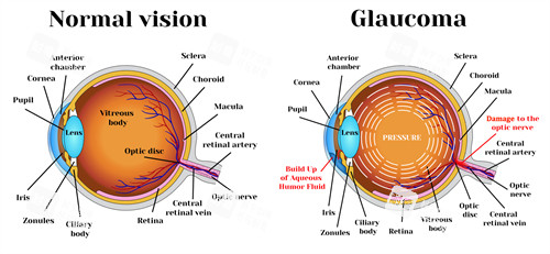 青光眼結(jié)構(gòu)