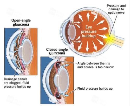 2026青光眼手術(shù)費用全知道！激光/小創(chuàng)口不同術(shù)式價格對比，附報銷政策解讀！