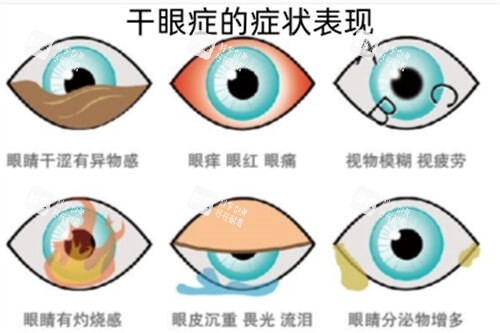 干眼癥的癥狀及表現(xiàn)