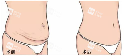美人魚腹壁成形手術(shù)前后的區(qū)別