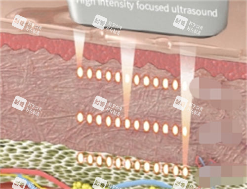 不同激光儀器作用在皮膚的深度展示圖