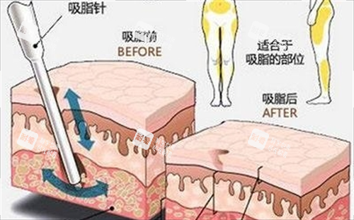 吸脂前后脂肪數(shù)量變化對(duì)比 吸脂前后脂肪數(shù)量變化對(duì)比