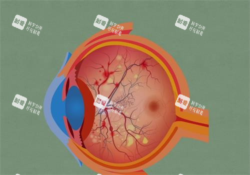 視網(wǎng)膜色素變性的眼睛