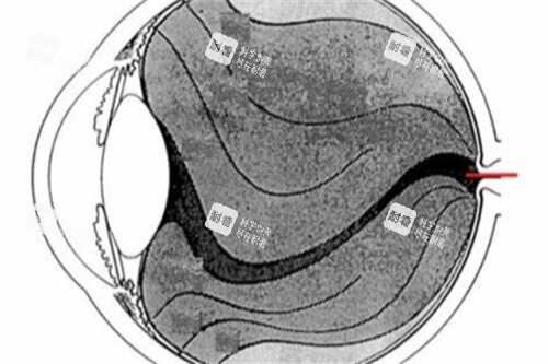 飛蚊癥眼球結(jié)構(gòu)
