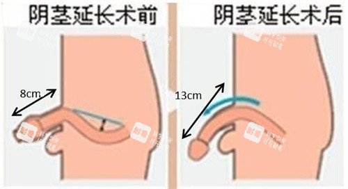 陰莖增長手術前后對比動畫圖