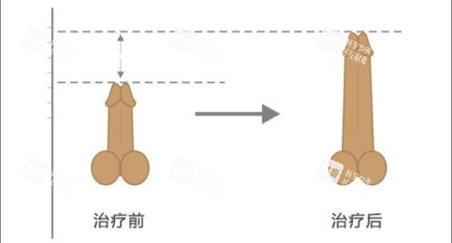 陰莖增長手術前后長度對比動畫圖