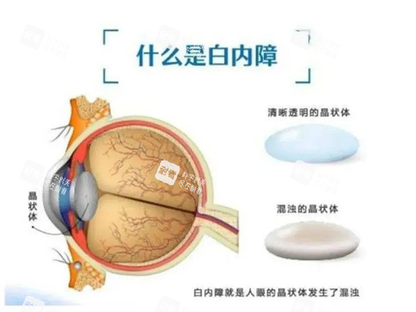 什么是白內(nèi)障 什么是白內(nèi)障