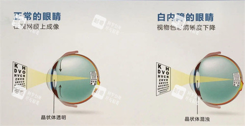 白內障的眼睛示意圖 白內障的眼睛示意圖