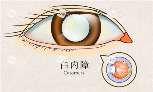 老年人免費割白內(nèi)障是騙局嗎？揭秘背后真相，教你如何避免上當(dāng)受騙！