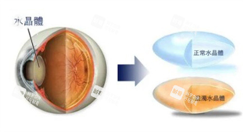 白內障的水晶體 白內障的水晶體