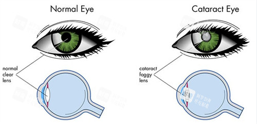 正常眼睛和白內障眼睛晶體區(qū)別 正常眼睛和白內障眼睛晶體區(qū)別