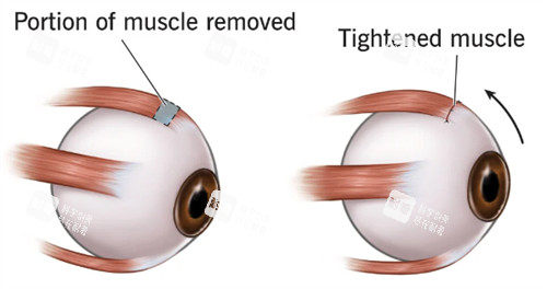 斜視眼睛肌肉和正常眼睛肌肉不同 斜視眼睛肌肉和正常眼睛肌肉不同