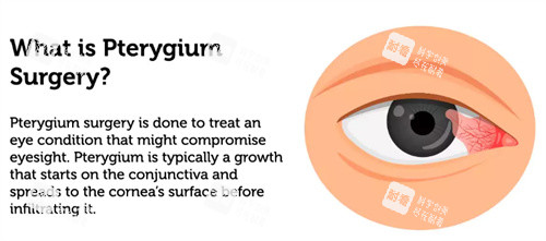 什么是眼睛翼狀胬肉 什么是眼睛翼狀胬肉