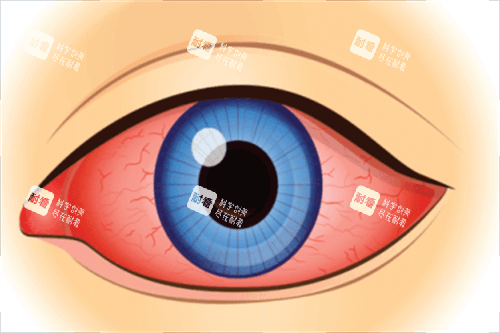 眼睛通紅 眼睛通紅