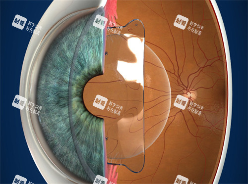 進(jìn)行晶體植入的眼睛 進(jìn)行晶體植入的眼睛