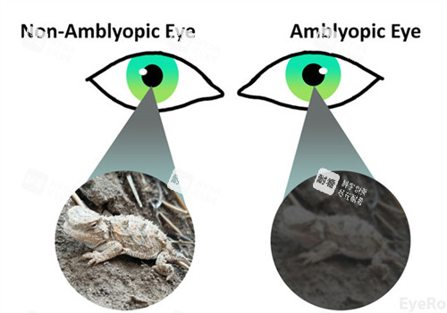 弱視和正常眼睛看物體不同 弱視和正常眼睛看物體不同
