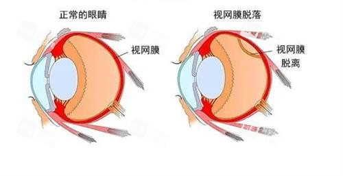 視網(wǎng)膜脫落的眼睛和正常眼睛的對(duì)比 視網(wǎng)膜脫落的眼睛和正常眼睛的對(duì)比